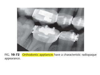 Intraoral radiographic anatomy