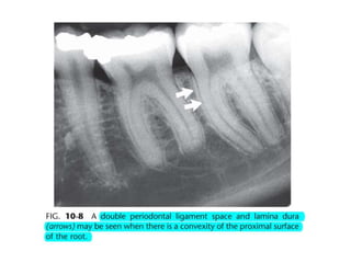Intraoral radiographic anatomy