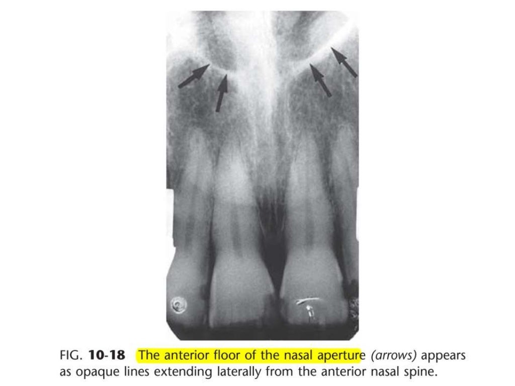 Intraoral radiographic anatomy