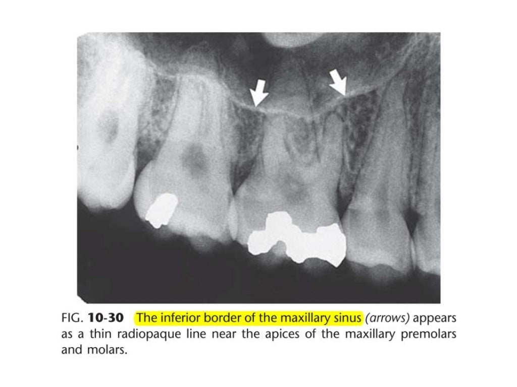 Intraoral radiographic anatomy
