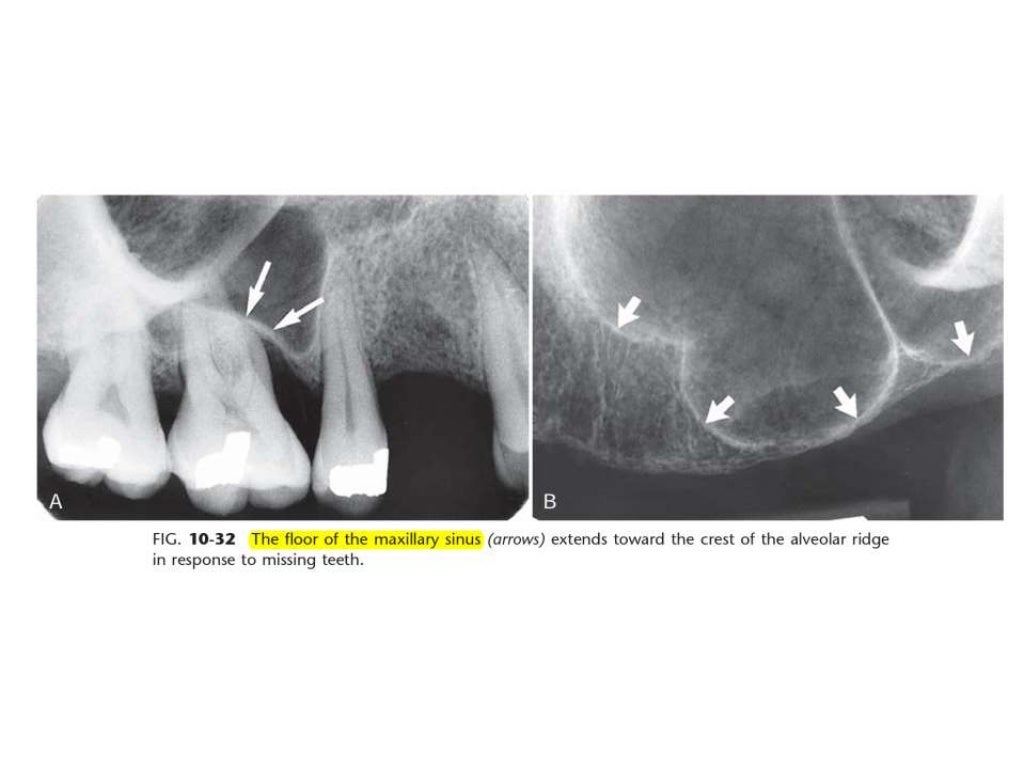 Intraoral radiographic anatomy