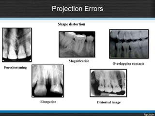 Projection Errors
Overlapping contacts
Foreshortening
Elongation
Shape distortion
Distorted image
Magnification
 