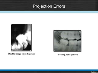 Projection Errors
Herring bone patternDouble image on radiograph
 