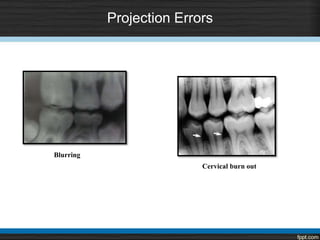 Projection Errors
Blurring
Cervical burn out
 