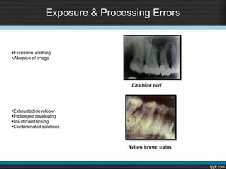 Exposure & Processing Errors
Yellow brown stains
Emulsion peel
Excessive washing
Abrasion of image
Exhausted developer
Prolonged developing
Insufficient rinsing
Contaminated solutions
 