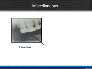 Miscellaneous
Phalangioma
 
