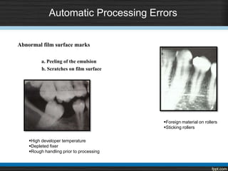 Automatic Processing Errors
Abnormal film surface marks
a. Peeling of the emulsion
b. Scratches on film surface
High developer temperature
Depleted fixer
Rough handling prior to processing
Foreign material on rollers
Sticking rollers
 