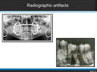 Radiographic artifacts
 