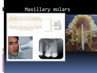 Maxillary molars
 