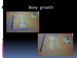 Bony growth
 