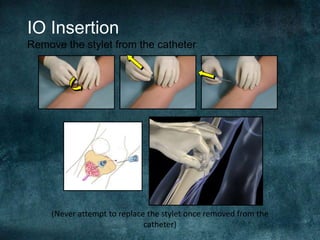 IO Insertion
Remove the stylet from the catheter
(Never attempt to replace the stylet once removed from the
catheter)
 