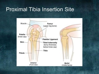 Proximal Tibia Insertion Site
 