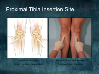 Proximal Tibia Insertion Site
Anterior (front) view
(Fingers on tibial tuberosities)
Actual insertion sites located
(Fingers on insertion sites)
 