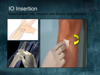 IO Insertion
Select proper site, prepare with alcohol and betadine
 