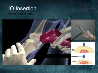 IO Insertion
Power the driver
Check the 5 mm mark!
 