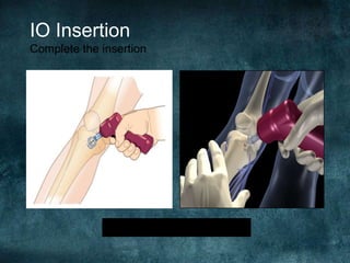 IO Insertion
Complete the insertion
“Stop when you feel the pop”
 