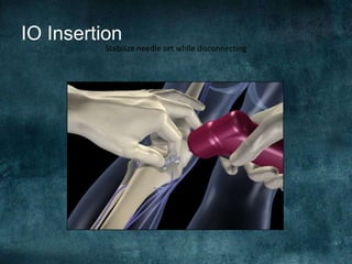 IO Insertion
Stabilize needle set while disconnecting
 