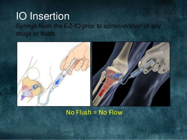 Intraosseous infusion mhs 536