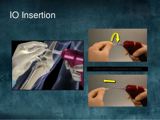 Intraosseous infusion mhs 536