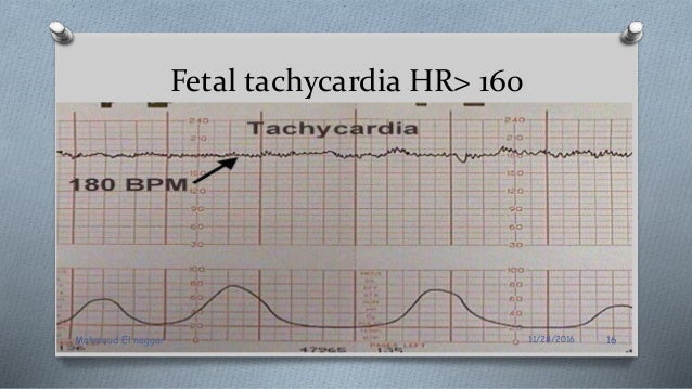 Intrapartum Assessment Of Fetal Wellbeing