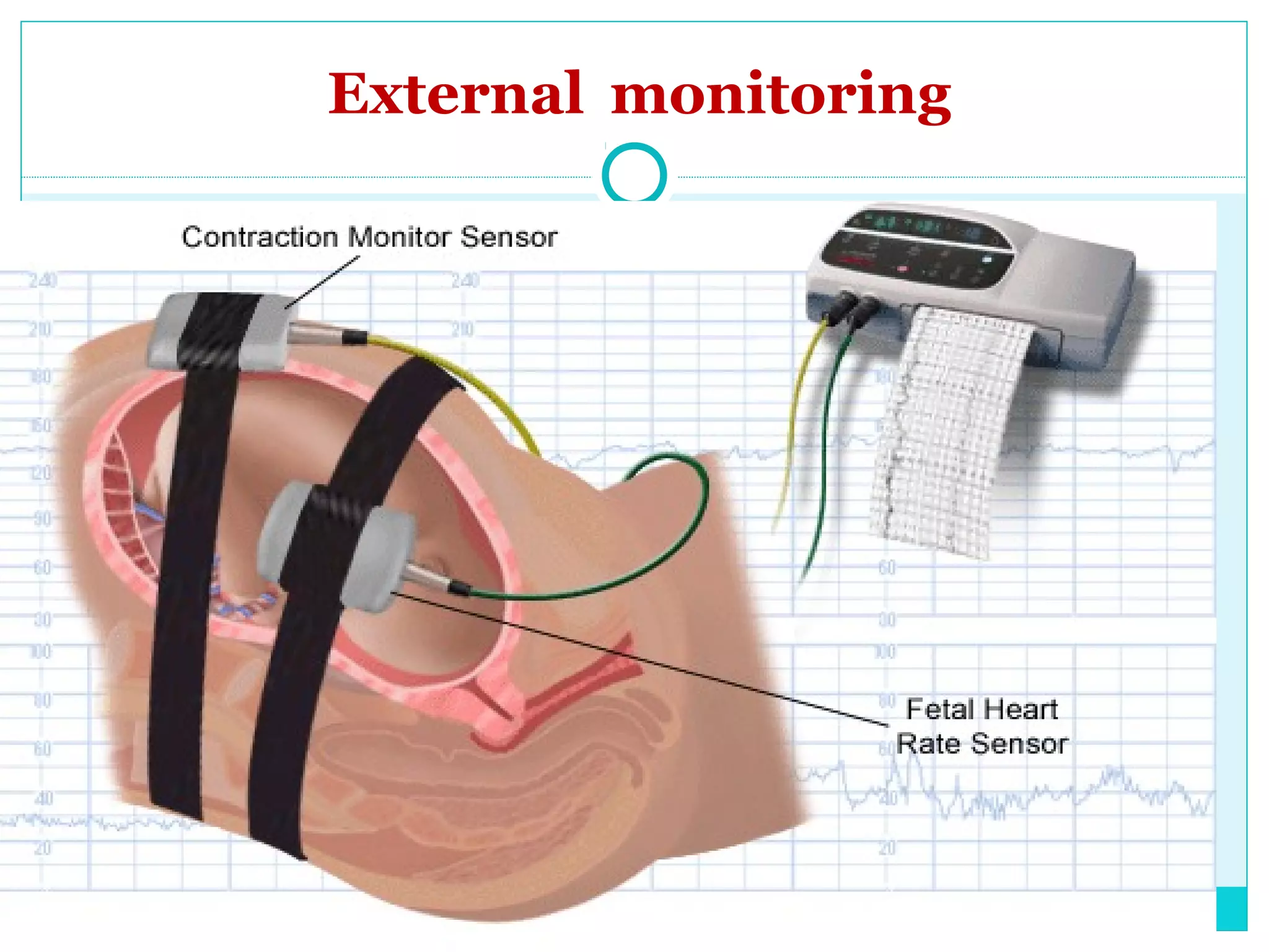 External Dopper Intrapartum fetal monitoring for undergraduate | PPT