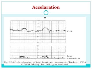 Intrapartum fetal monitoring for undergraduate | PPT