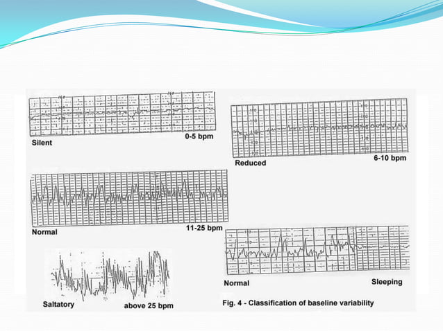 Intrapartum Fetal Survellence