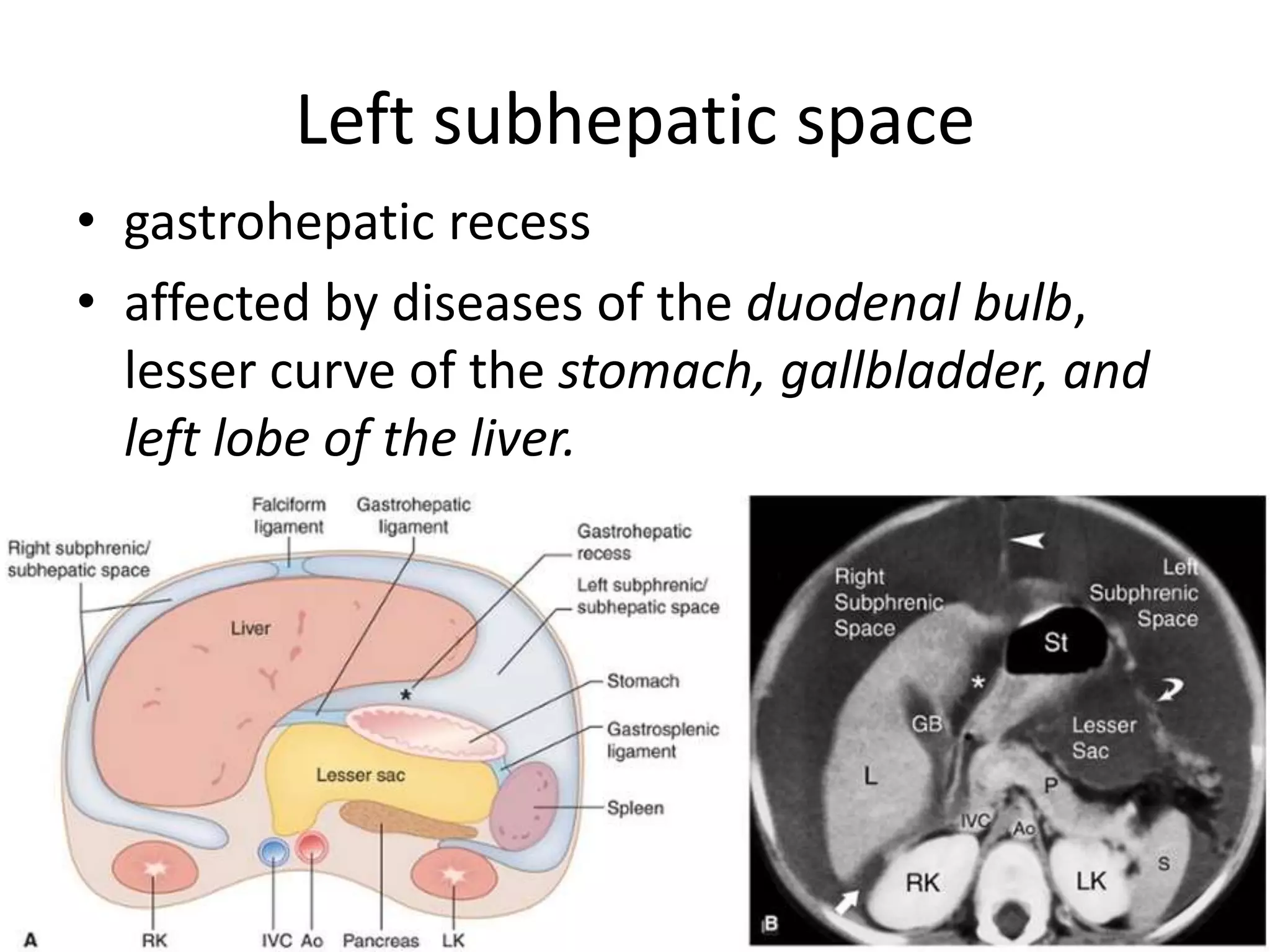 Left subhepatic space
• gastrohepatic recess
• affected by diseases of the duodenal bulb,
lesser curve of the stomach, gallbladder, and
left lobe of the liver.
 