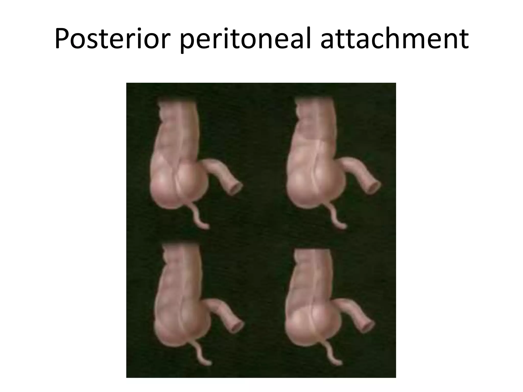 Posterior peritoneal attachment
 