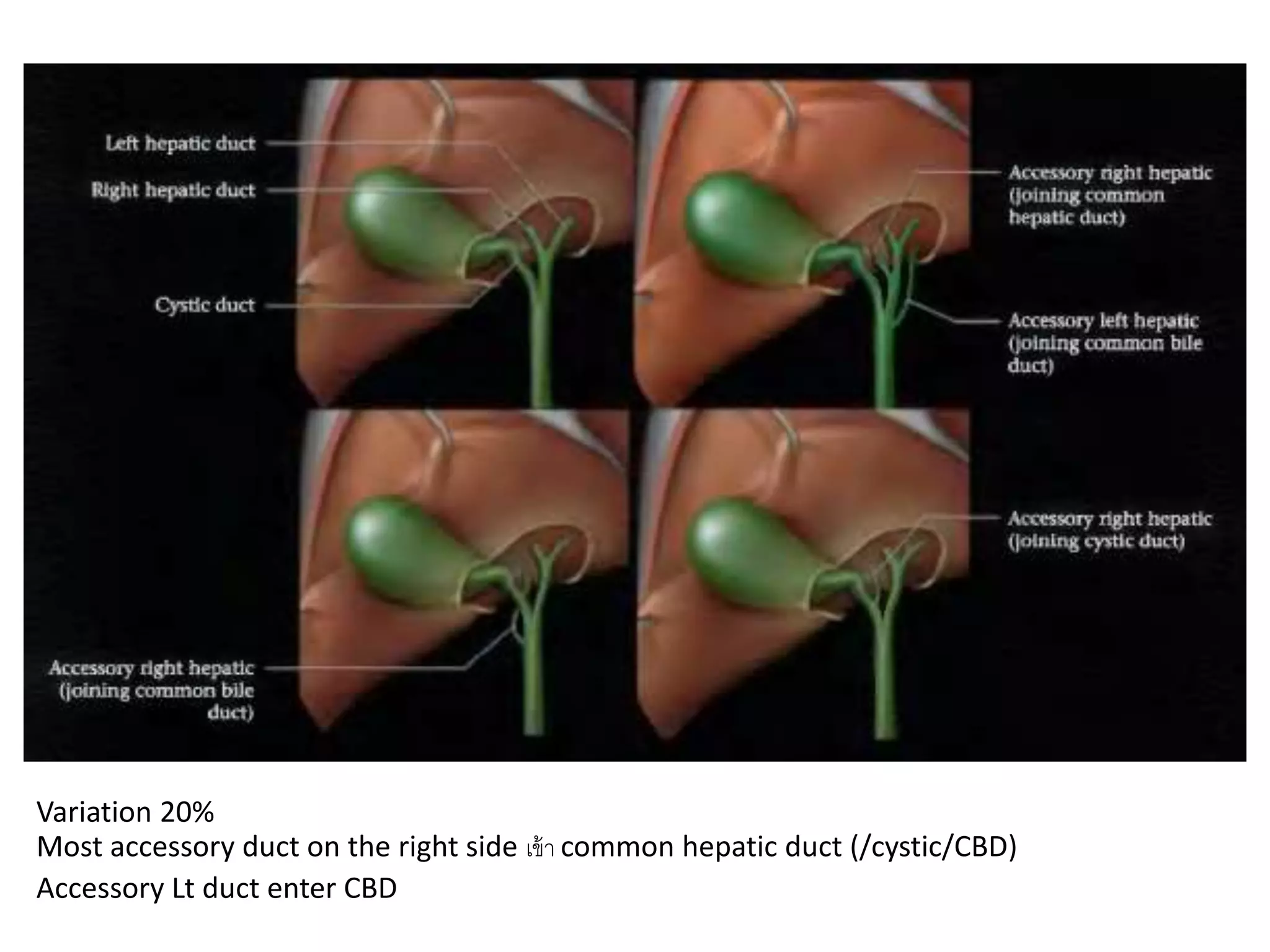 Variation 20%
Most accessory duct on the right side เข้า common hepatic duct (/cystic/CBD)
Accessory Lt duct enter CBD
 