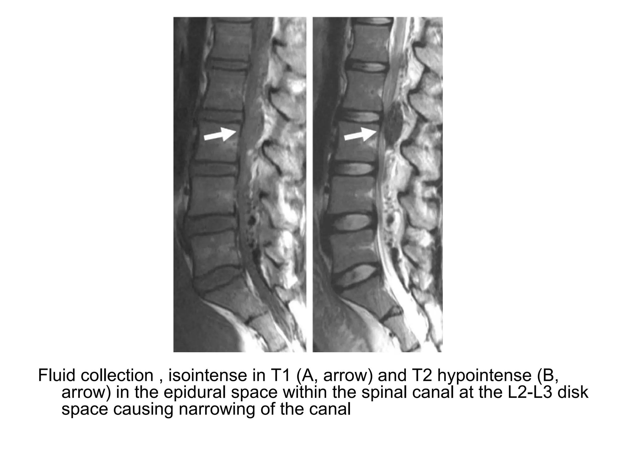diagnostic-imaging-of-intraspinal-masses-ppt