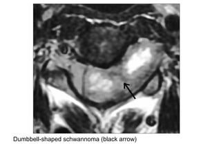 Diagnostic Imaging of Intraspinal Masses | PPT