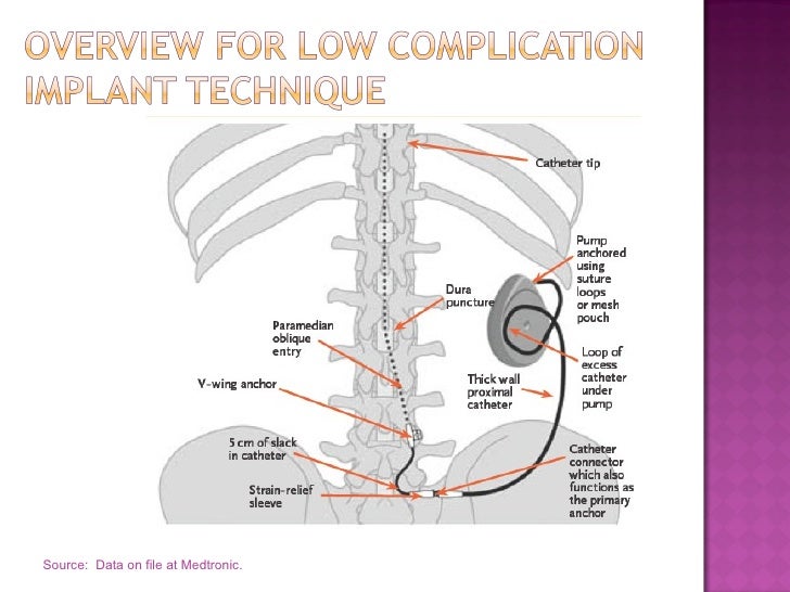 Baclofen Pump Insertion