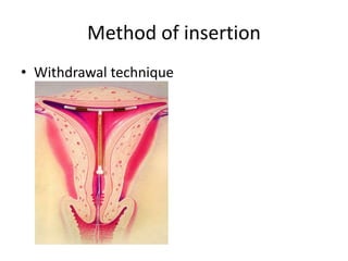 Method of insertion
• Withdrawal technique
 