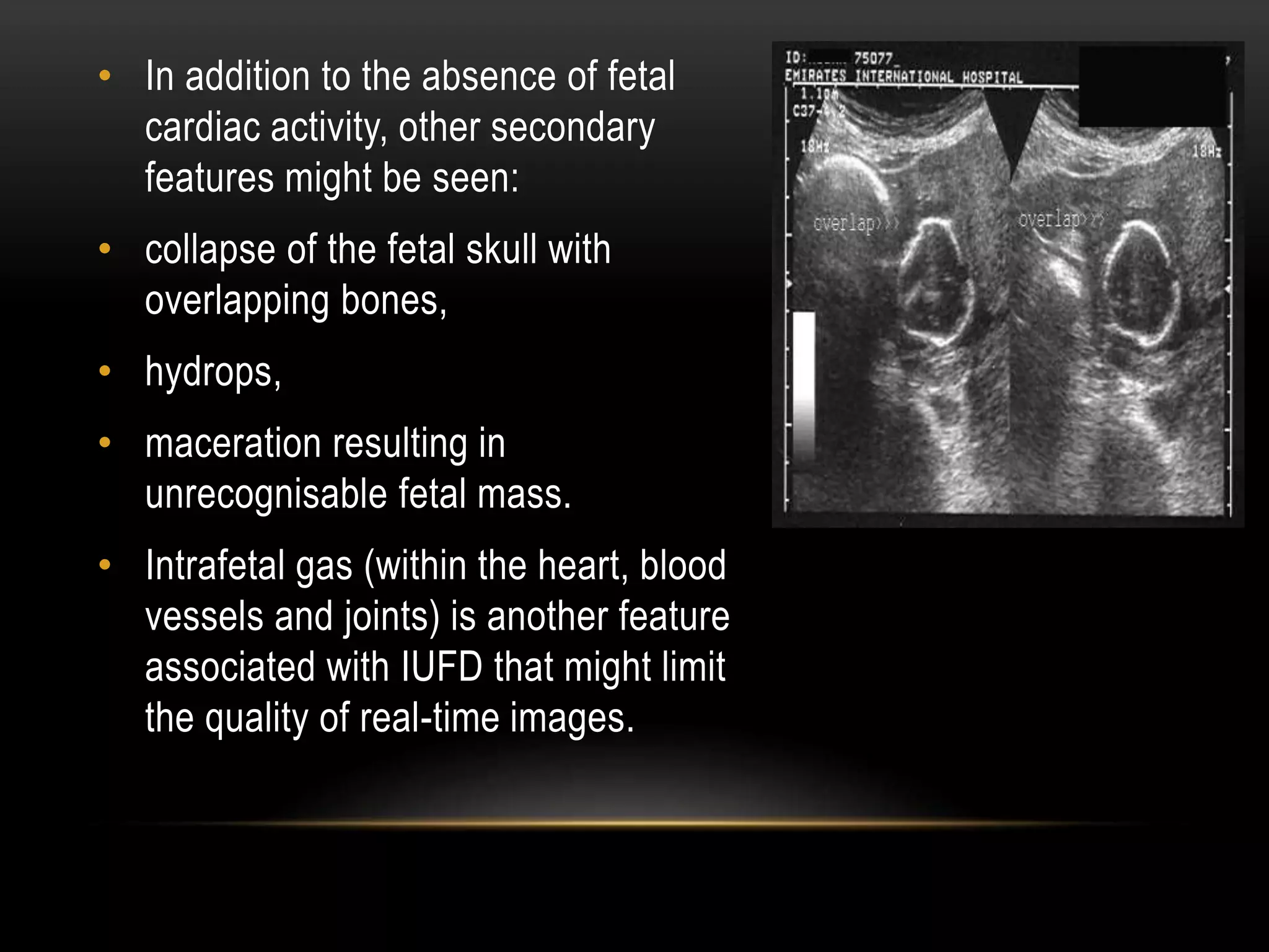 • In addition to the absence of fetal
cardiac activity, other secondary
features might be seen:
• collapse of the fetal skull with
overlapping bones,
• hydrops,
• maceration resulting in
unrecognisable fetal mass.
• Intrafetal gas (within the heart, blood
vessels and joints) is another feature
associated with IUFD that might limit
the quality of real-time images.
 