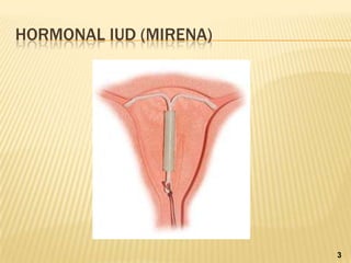 HORMONAL IUD (MIRENA)
3
 