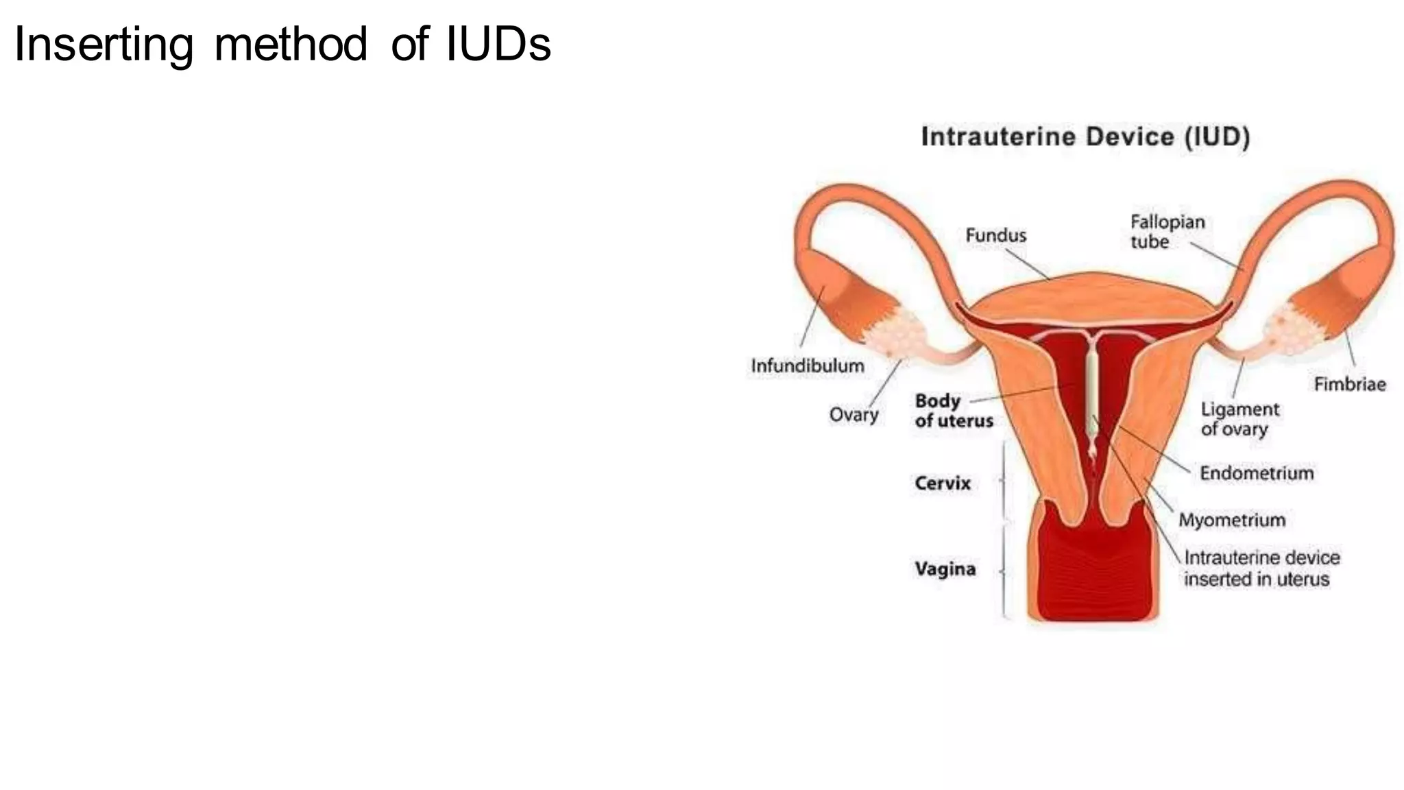INTRAUTERINE DRUG DELIVERY SYSTEM.docx