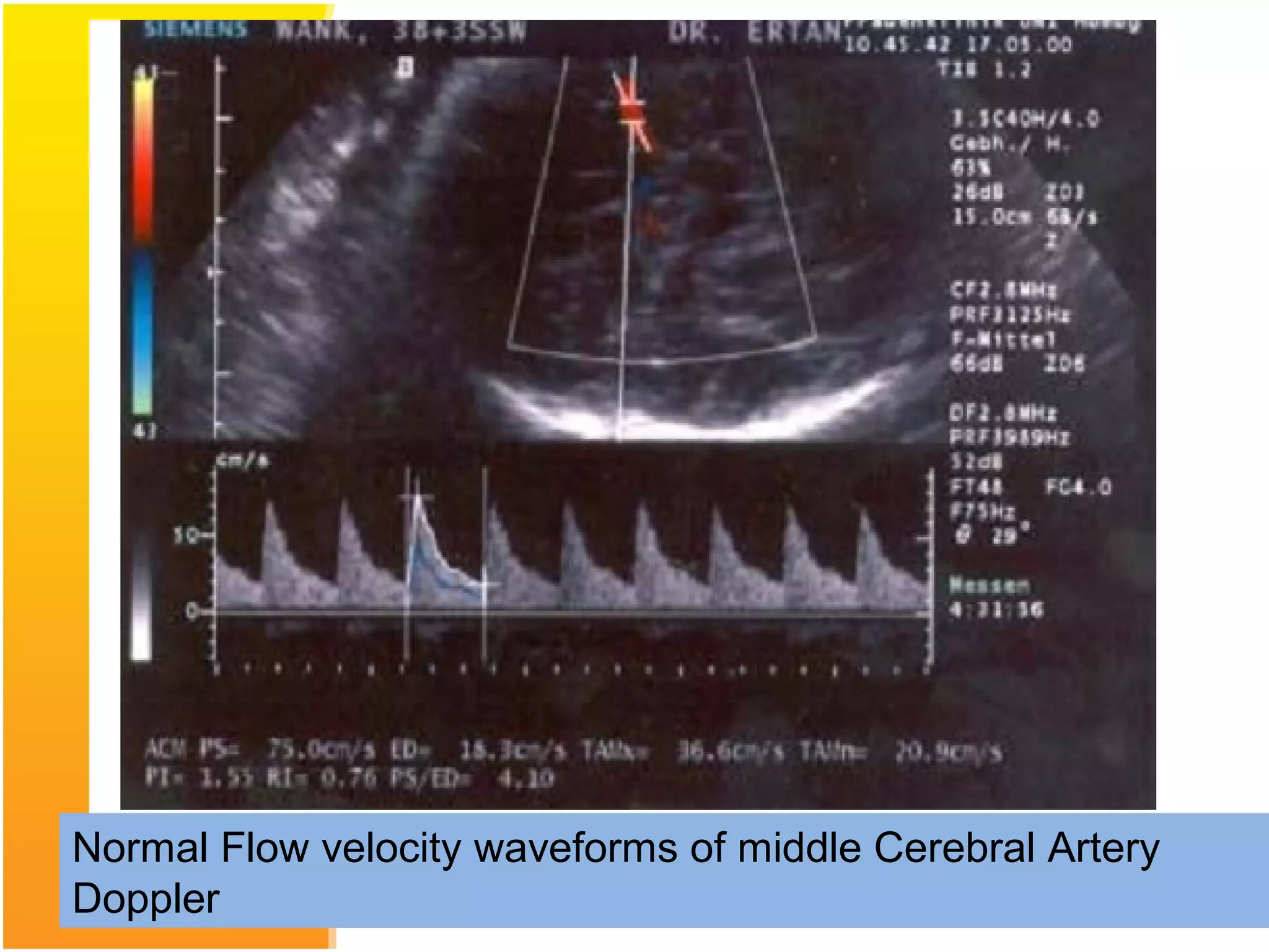 Normal Flow velocity waveforms of middle Cerebral Artery
Doppler
 