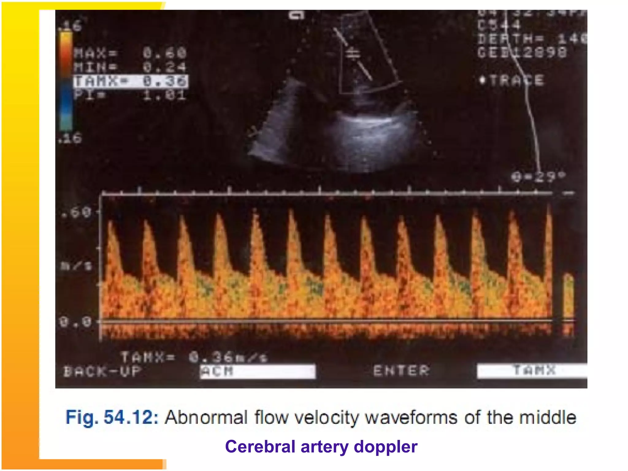 Cerebral artery doppler
 