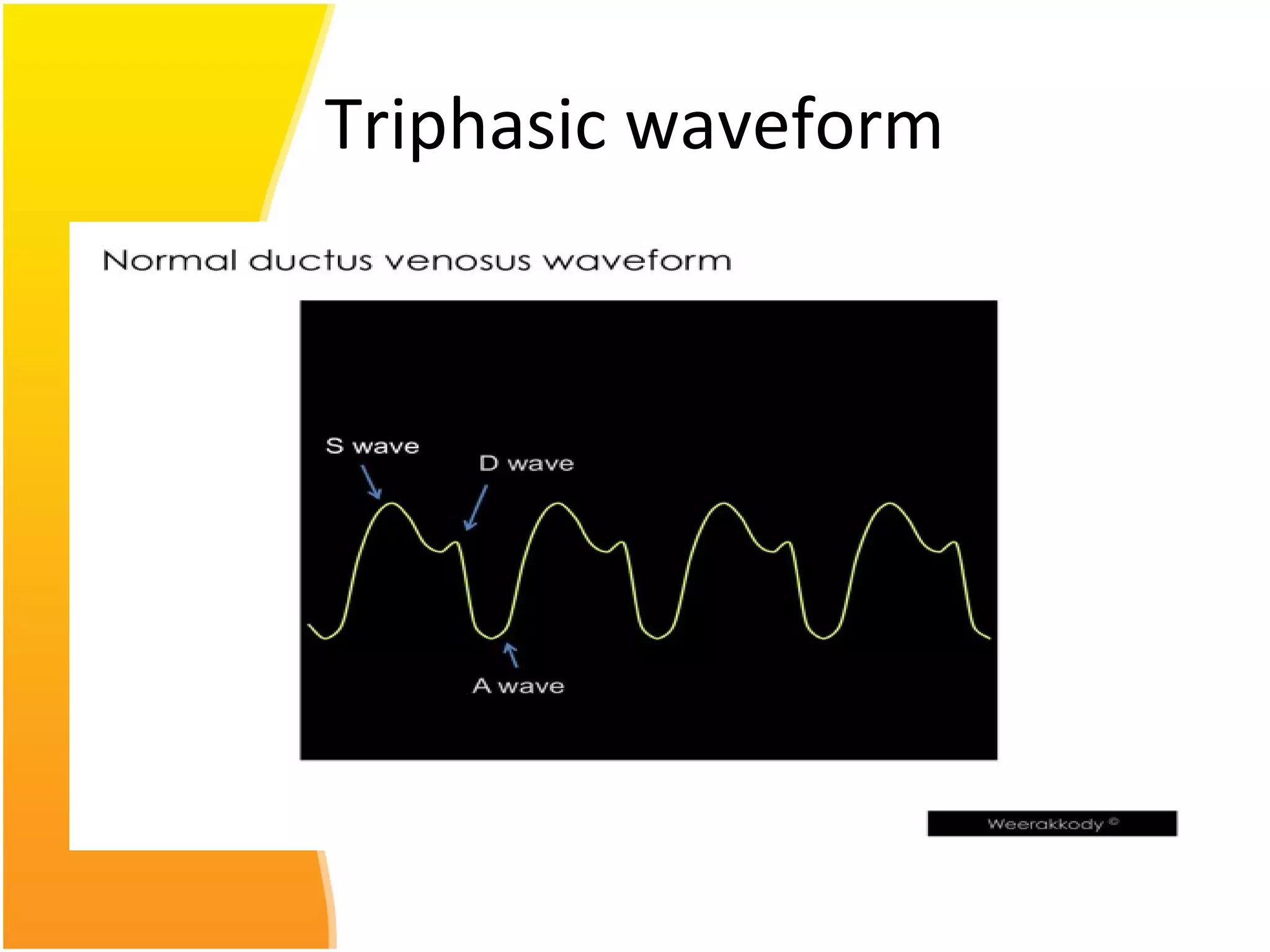 Triphasic waveform
 