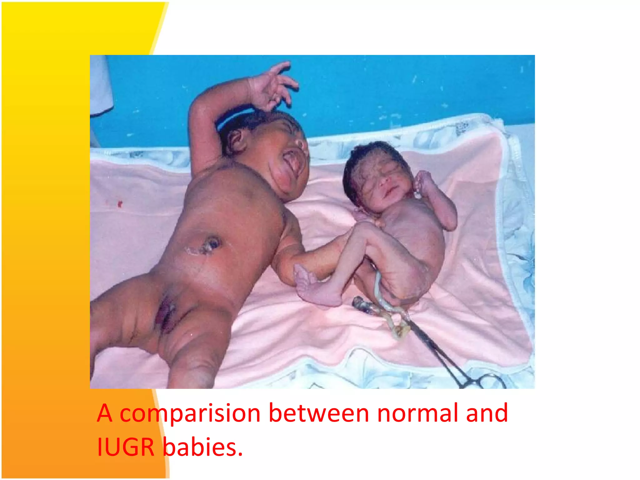 A comparision between normal and
IUGR babies.
 