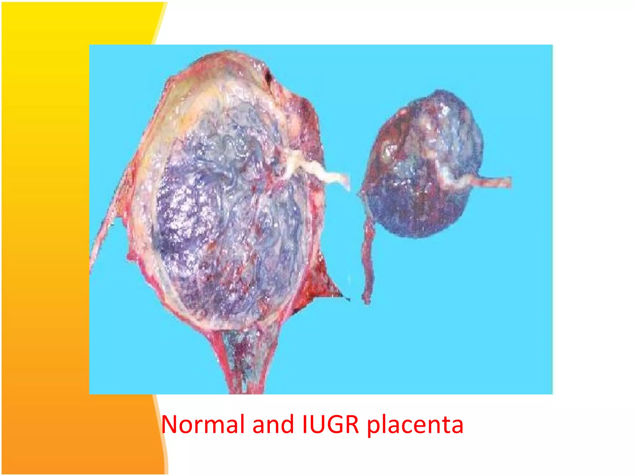 Normal and IUGR placenta
 