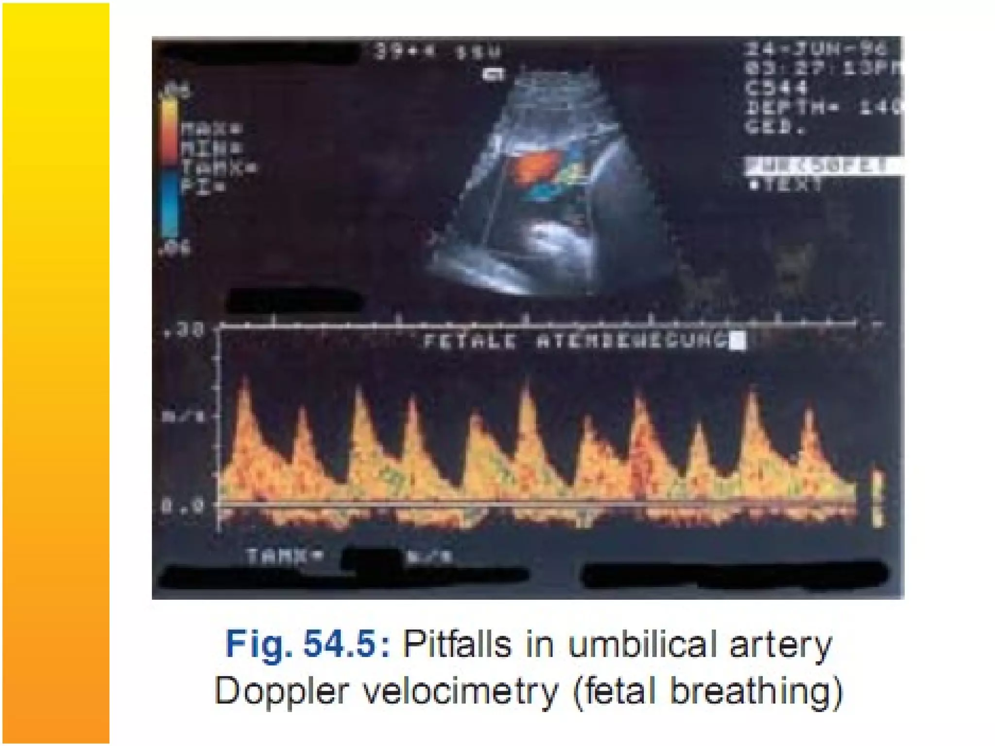 Spicy Food in Pregnancy: Is It Safe for You and Your Baby?