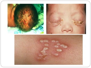 Torch Infection Rashes INTRAUTERINE INFECTIONS (TORCH INFECTIONS) | PPTX