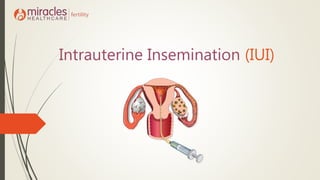Intrauterine Insemination (IUI)
 
