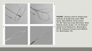Forign Loop intravascular foreign body retrieval.pdf