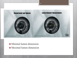  Minimal lumen dimension
 Maximal lumen dimension
18
 