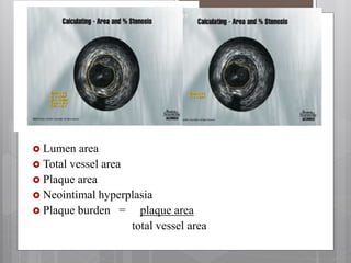  Lumen area
 Total vessel area
 Plaque area
 Neointimal hyperplasia
 Plaque burden = plaque area
total vessel area
19
 