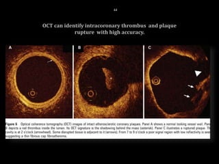 OCT can identify intracoronary thrombus and plaque
rupture with high accuracy.
44
 