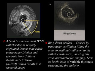  A bend in a mechanical IVUS
catheter due to severely
angulated lesions may cause
unnecessary friction and
generate Non-Uniform
Rotational Distortion
(NURD), which results in a
smeared image
 Ring-down artifact -- Caused by
transducer oscillation filling the
area immediately adjacent to the
catheter with noise, making this
area unavailable for imaging. Seen
as bright halo of variable thickness
surrounding the catheter.
58
 